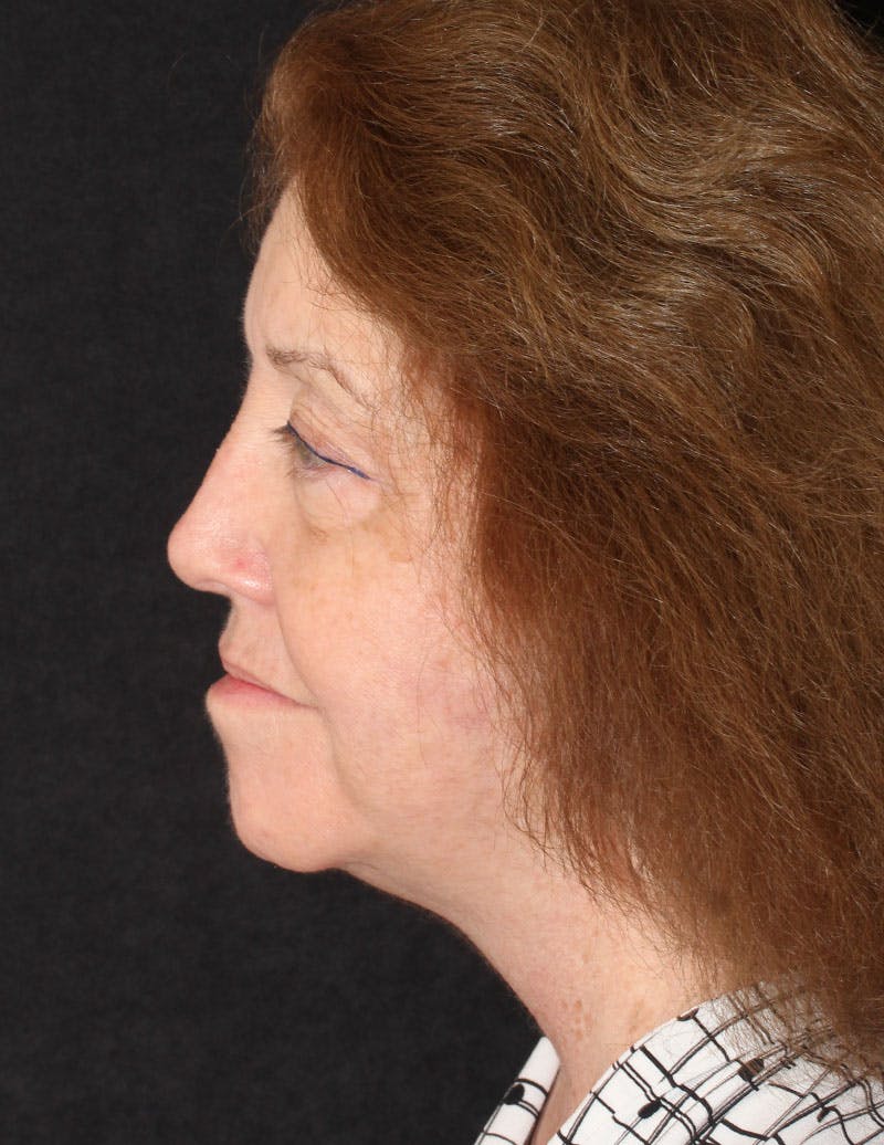 Facelift/Necklift Before & After Gallery - Patient 487195 - Image 8