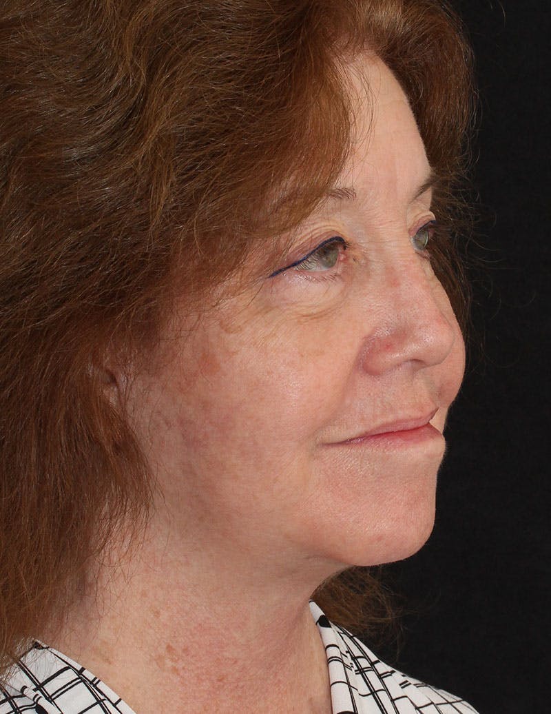 Facelift/Necklift Before & After Gallery - Patient 487195 - Image 4