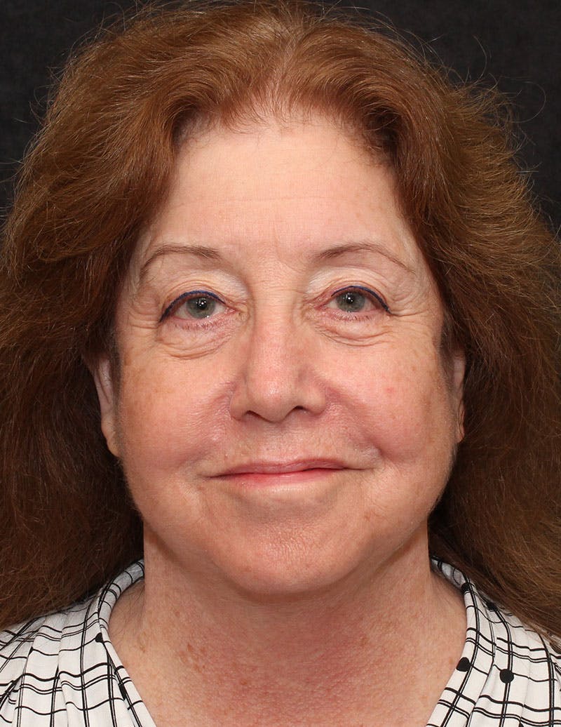 Facelift/Necklift Before & After Gallery - Patient 487195 - Image 2