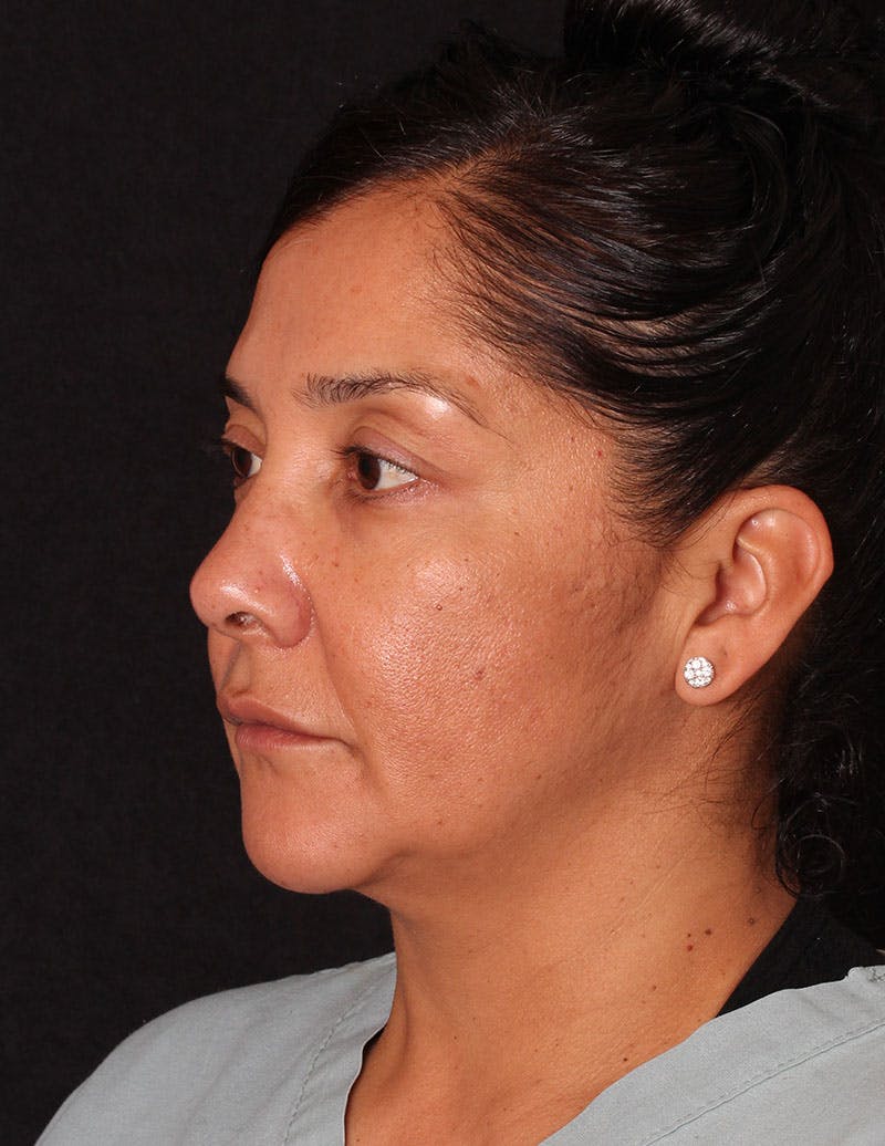Facelift/Necklift Before & After Gallery - Patient 246473 - Image 9