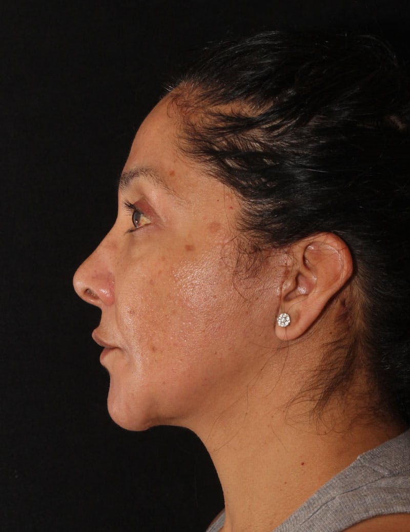 Facelift/Necklift Before & After Gallery - Patient 246473 - Image 8
