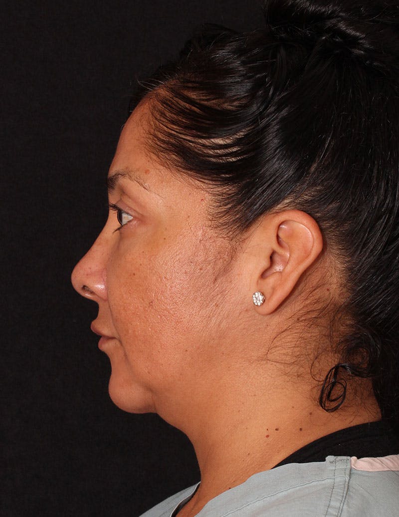 Facelift/Necklift Before & After Gallery - Patient 246473 - Image 7
