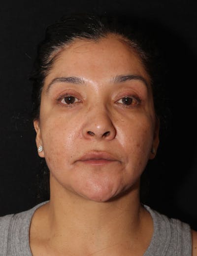 Facelift/Necklift Before & After Gallery - Patient 246473 - Image 2