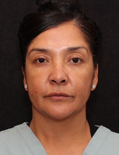 Facelift/Necklift Before & After Gallery - Patient 246473 - Image 1