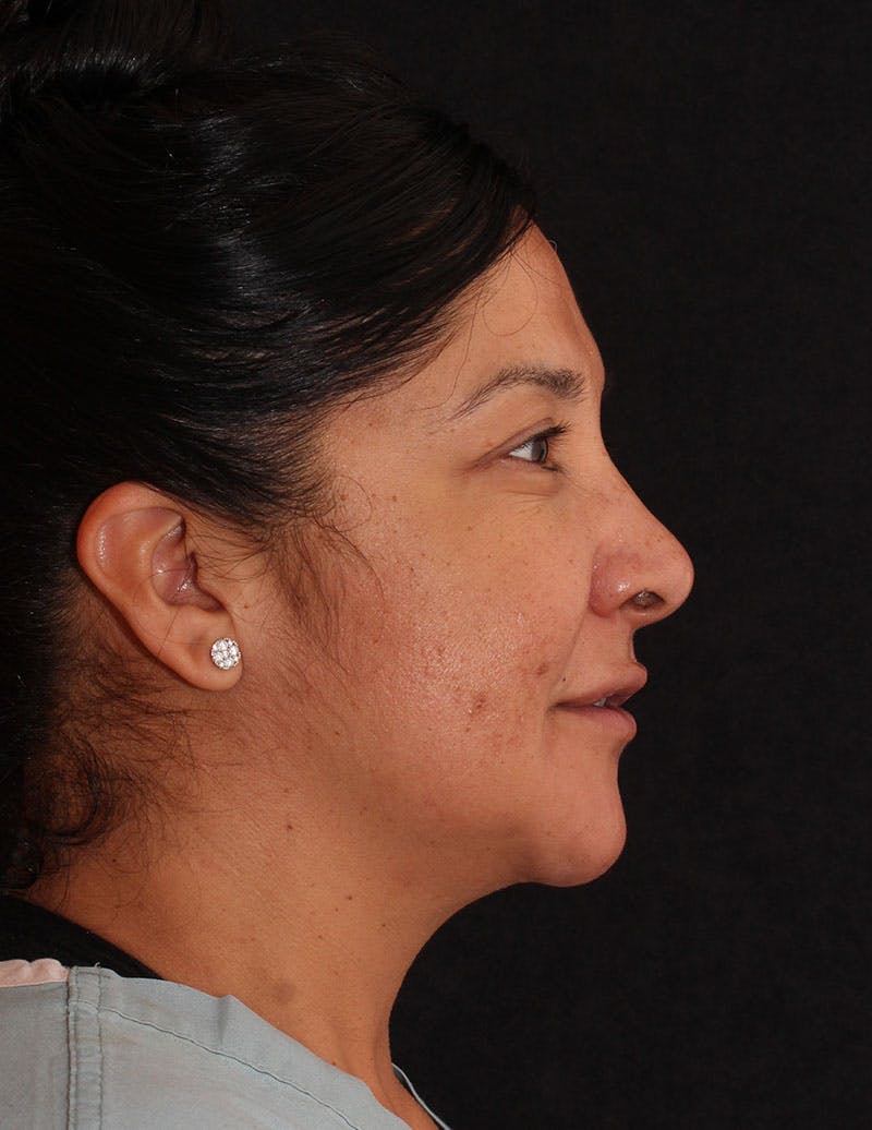 Facelift/Necklift Before & After Gallery - Patient 246473 - Image 5