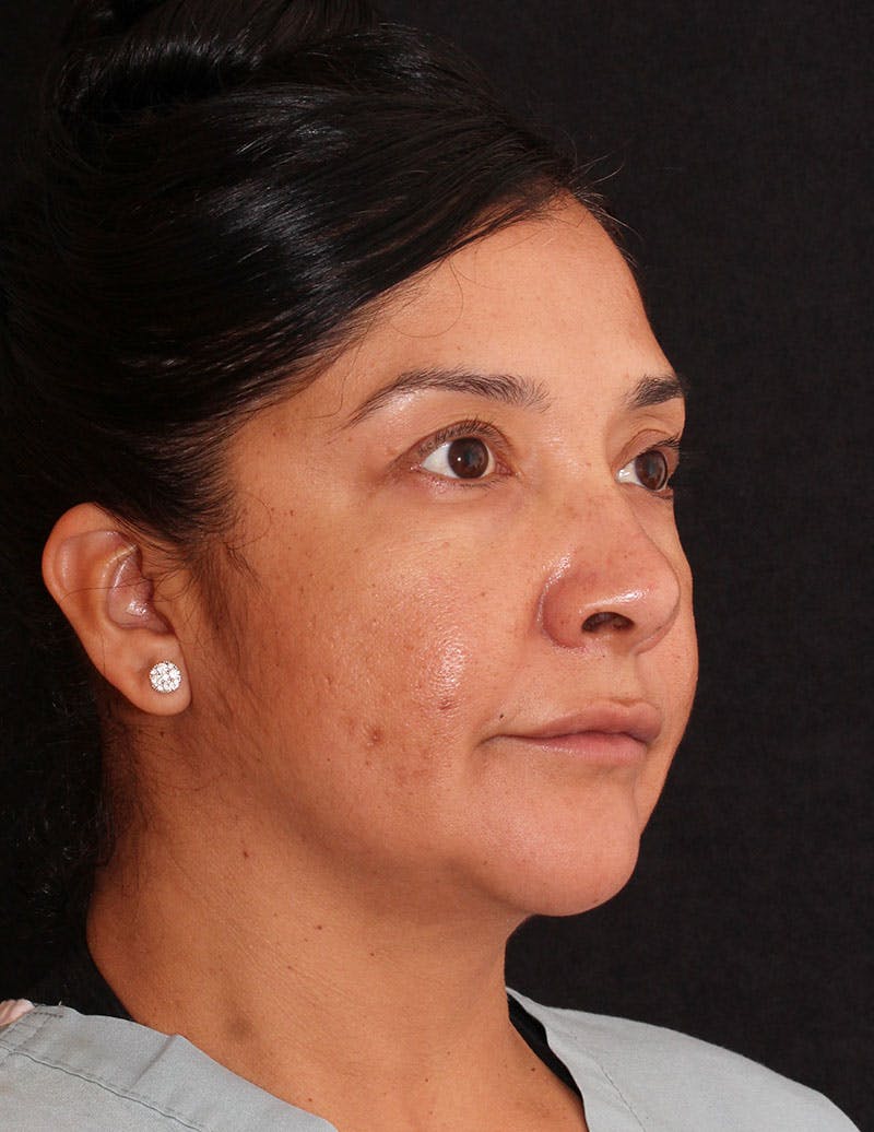 Facelift/Necklift Before & After Gallery - Patient 246473 - Image 3