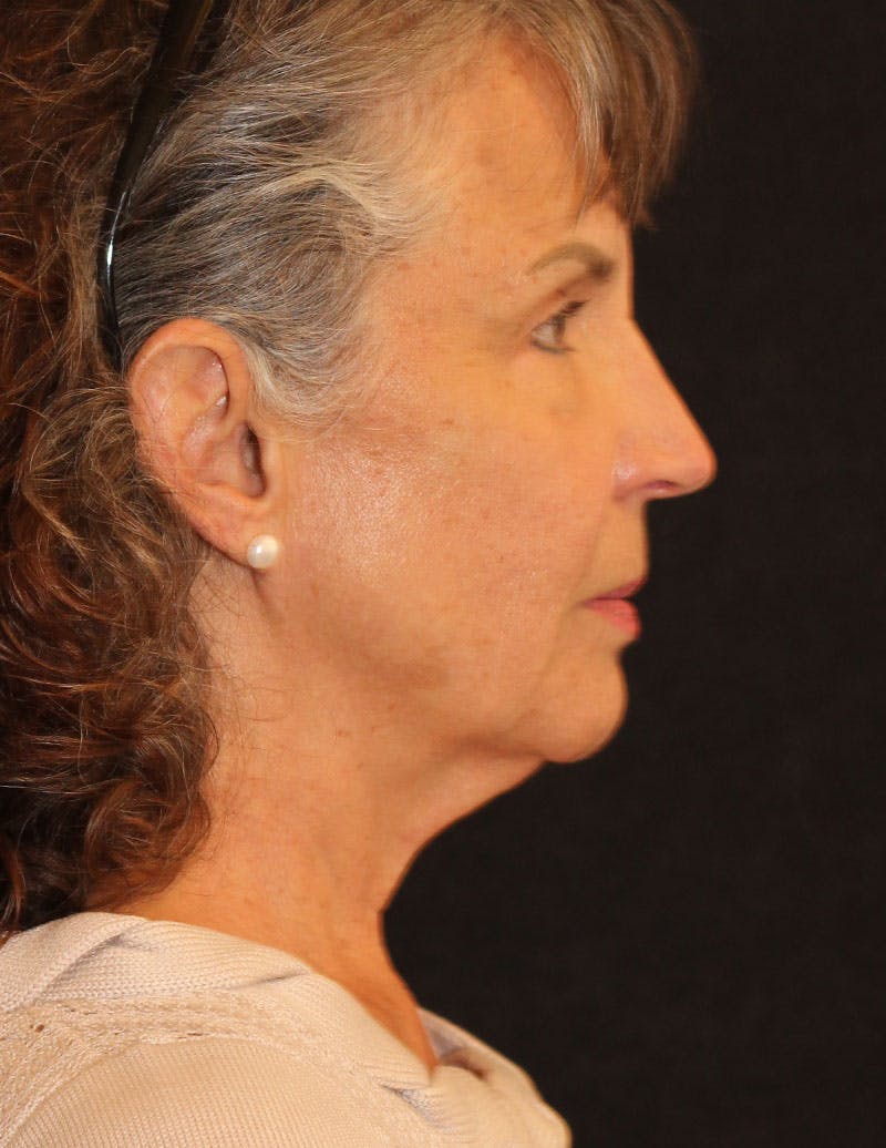 Facelift/Necklift Before & After Gallery - Patient 231109 - Image 3