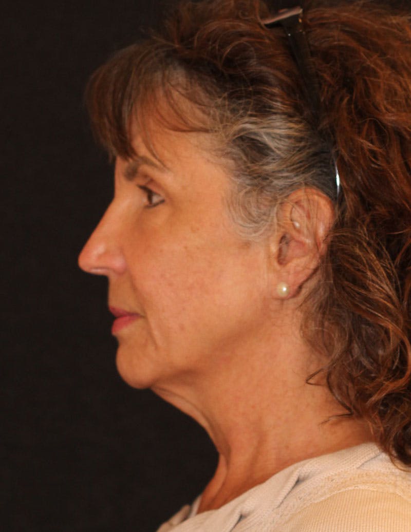 Facelift/Necklift Before & After Gallery - Patient 231109 - Image 5