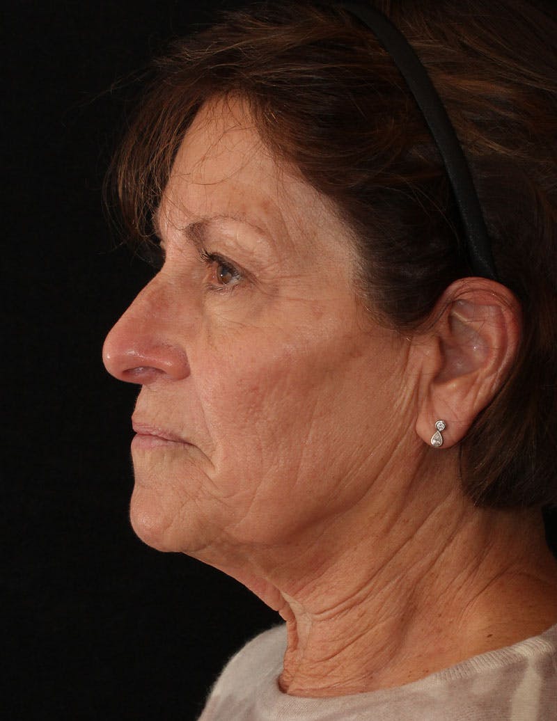 Facelift/Necklift Before & After Gallery - Patient 867024 - Image 7