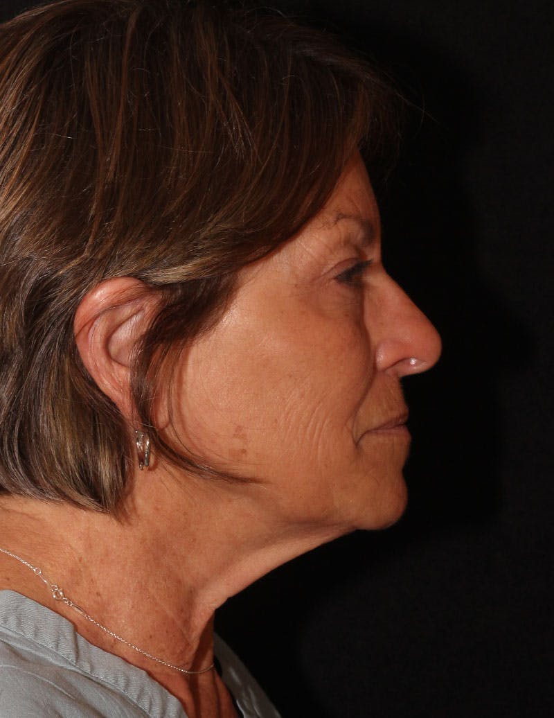 Facelift/Necklift Before & After Gallery - Patient 867024 - Image 6