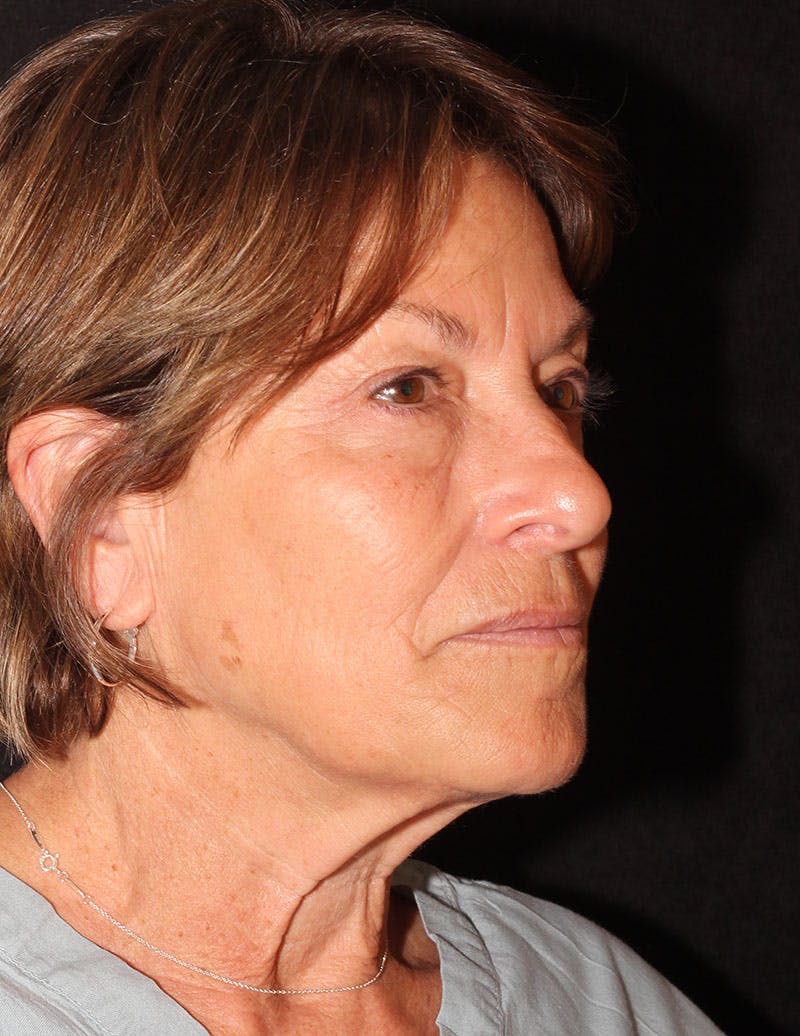 Facelift/Necklift Before & After Gallery - Patient 867024 - Image 4