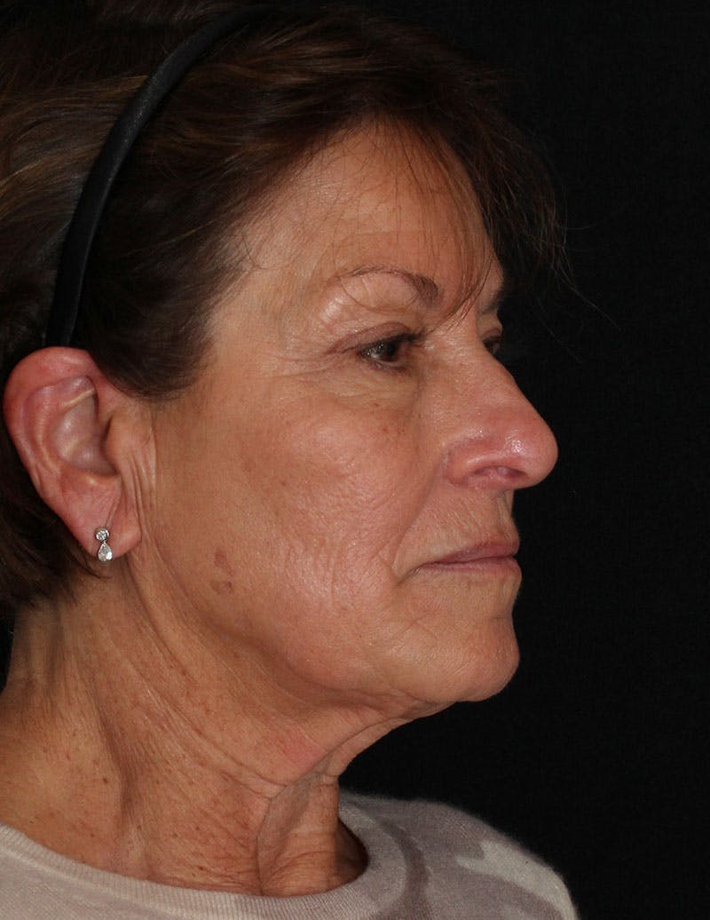 Facelift/Necklift Before & After Gallery - Patient 867024 - Image 3