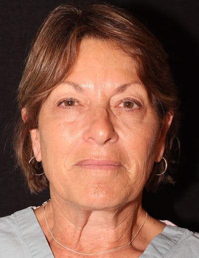 Facelift/Necklift Before & After Gallery - Patient 867024 - Image 2