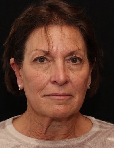 Facelift/Necklift Before & After Gallery - Patient 867024 - Image 1