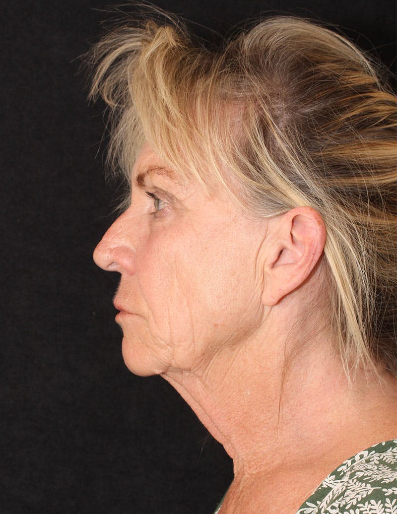 Facelift/Necklift Before & After Gallery - Patient 124893 - Image 7