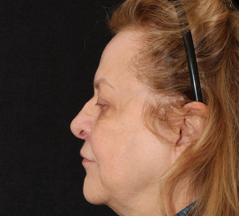 Browlift/Upper Blepharoplasty Before & After Gallery - Patient 368364 - Image 8