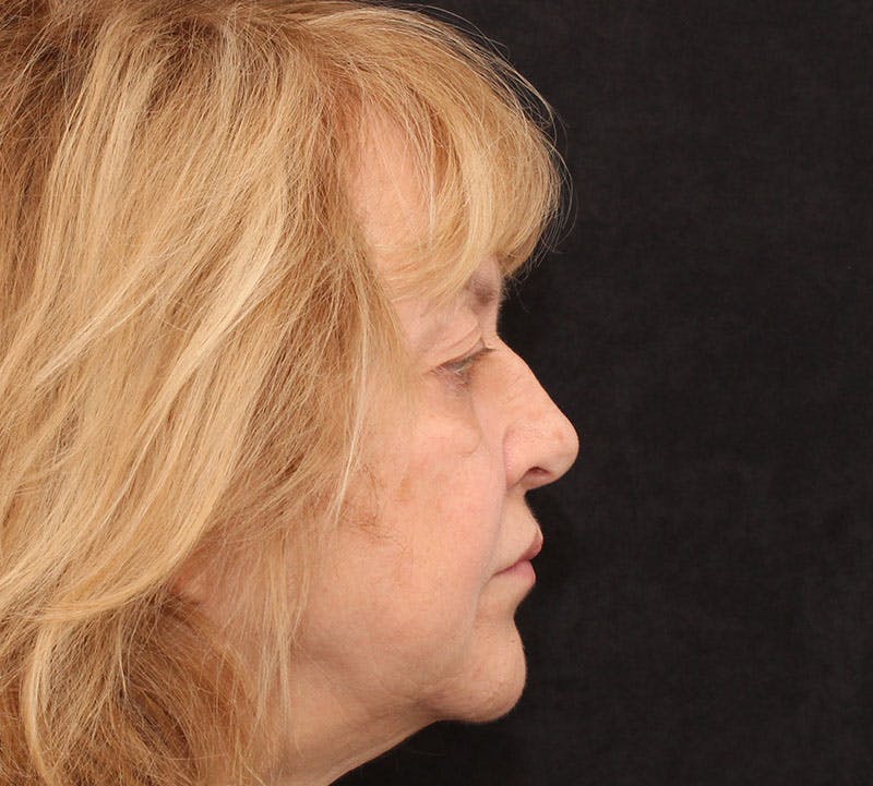 Browlift/Upper Blepharoplasty Before & After Gallery - Patient 368364 - Image 5