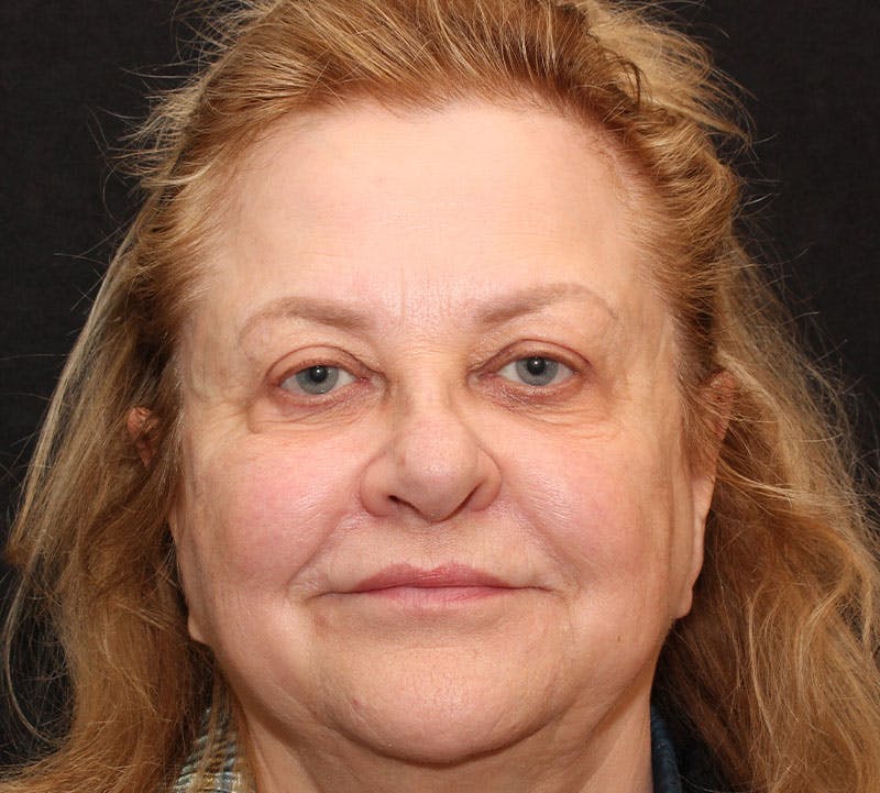 Browlift/Upper Blepharoplasty Before & After Gallery - Patient 368364 - Image 2