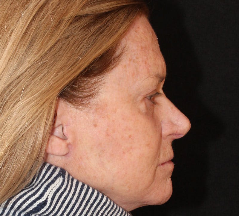 Browlift/Upper Blepharoplasty Before & After Gallery - Patient 225788 - Image 6