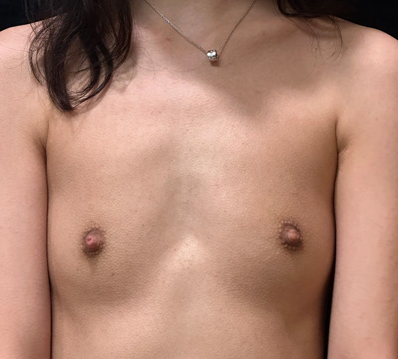 Breast Augmentation Before & After Gallery - Patient 346987 - Image 1
