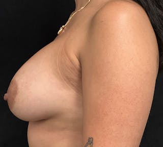 Breast Augmentation Before & After Gallery - Patient 772165 - Image 8