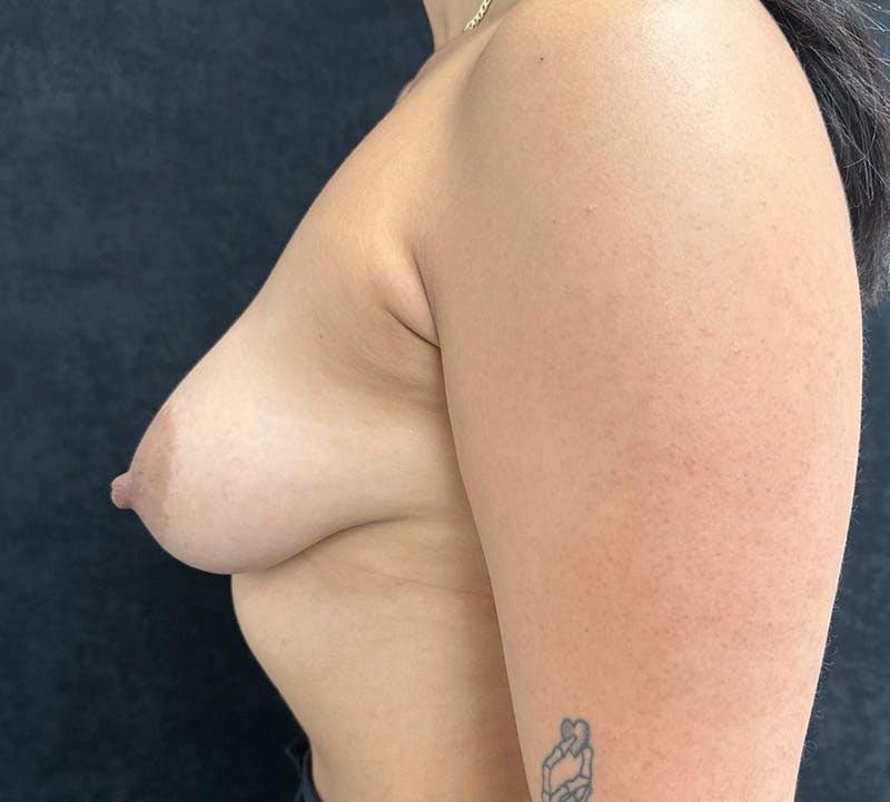 Breast Augmentation Before & After Gallery - Patient 772165 - Image 7