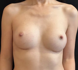 Breast Augmentation Before & After Gallery - Patient 535651 - Image 2