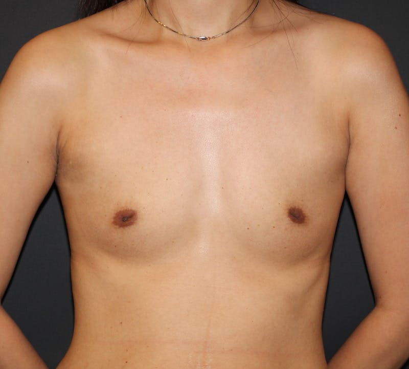 Nipple Inversion Before & After Gallery - Patient 699372 - Image 1