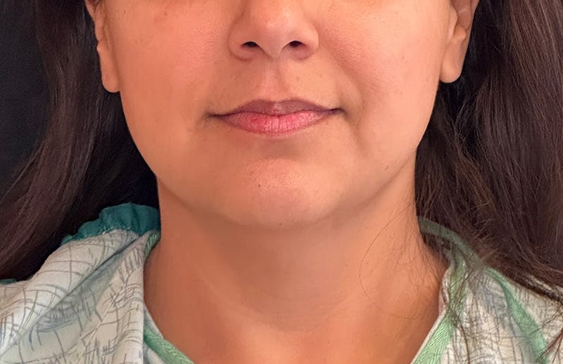MyEllevate® Neck Lift
