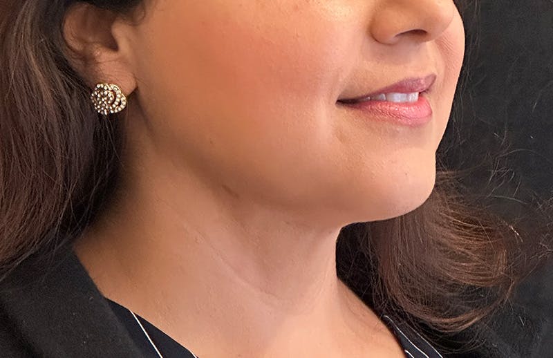 MyEllevate Before & After Gallery - Patient 380894 - Image 4