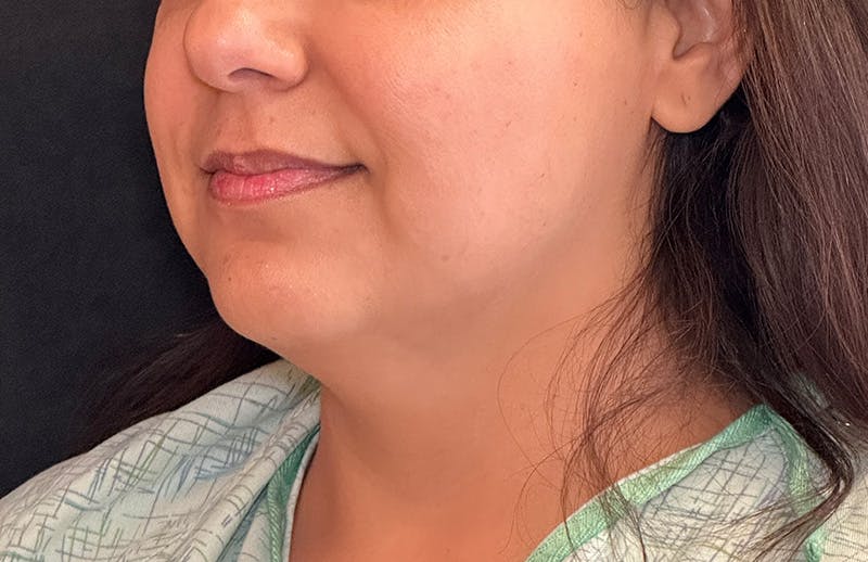 MyEllevate Before & After Gallery - Patient 380894 - Image 7