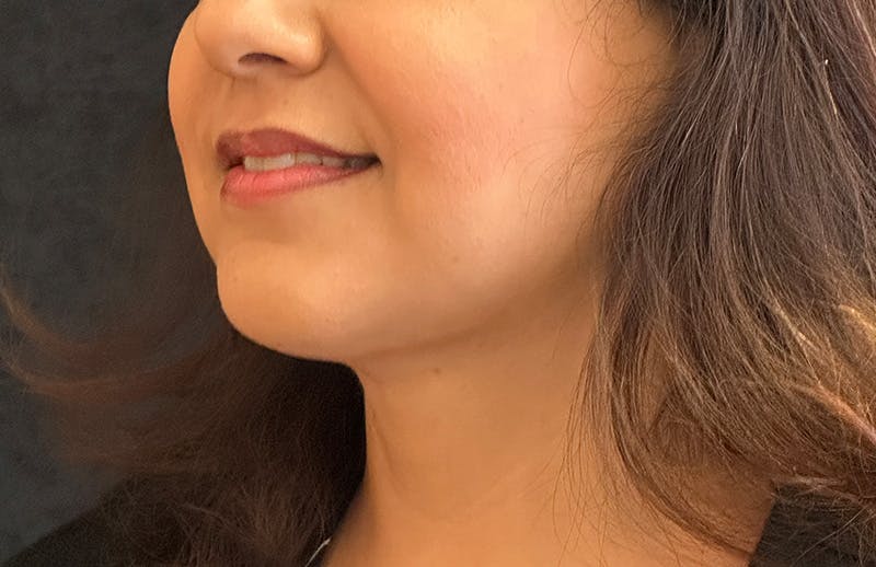 MyEllevate Before & After Gallery - Patient 380894 - Image 8