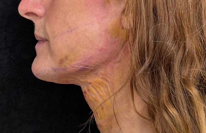 MyEllevate Before & After Gallery - Patient 235023 - Image 10