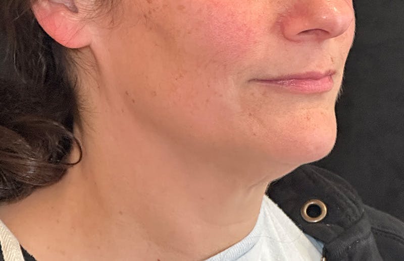 MyEllevate Before & After Gallery - Patient 372598 - Image 3