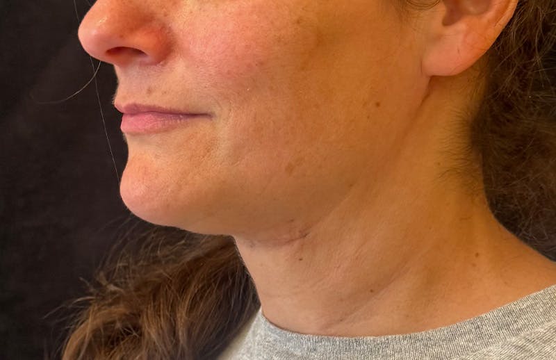 MyEllevate Before & After Gallery - Patient 372598 - Image 8