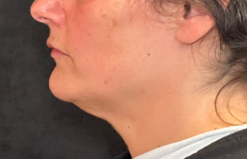 MyEllevate Before & After Gallery - Patient 372598 - Image 9