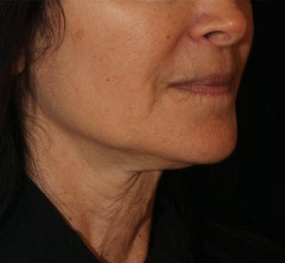 Ellacor Before & After Gallery - Patient 117628 - Image 1