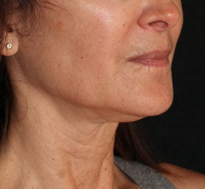 Ellacor Before & After Gallery - Patient 117628 - Image 2