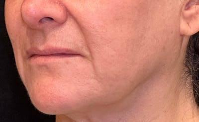 Ellacor Before & After Gallery - Patient 355294 - Image 2