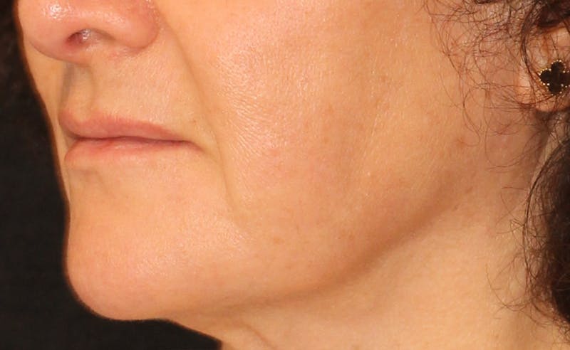 Ellacor Before & After Gallery - Patient 355294 - Image 1