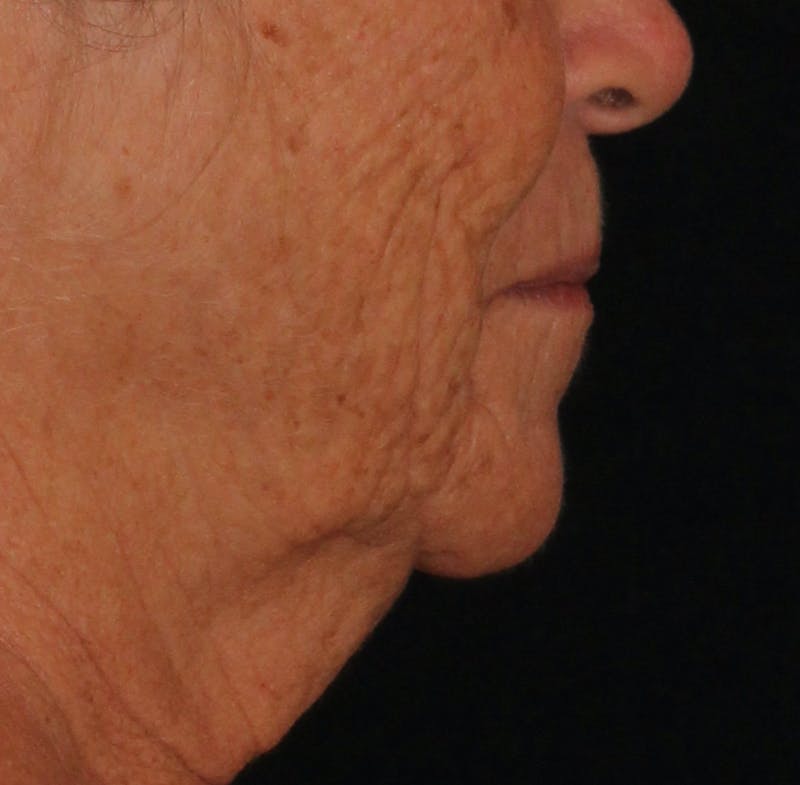 Ellacor Before & After Gallery - Patient 236761 - Image 1