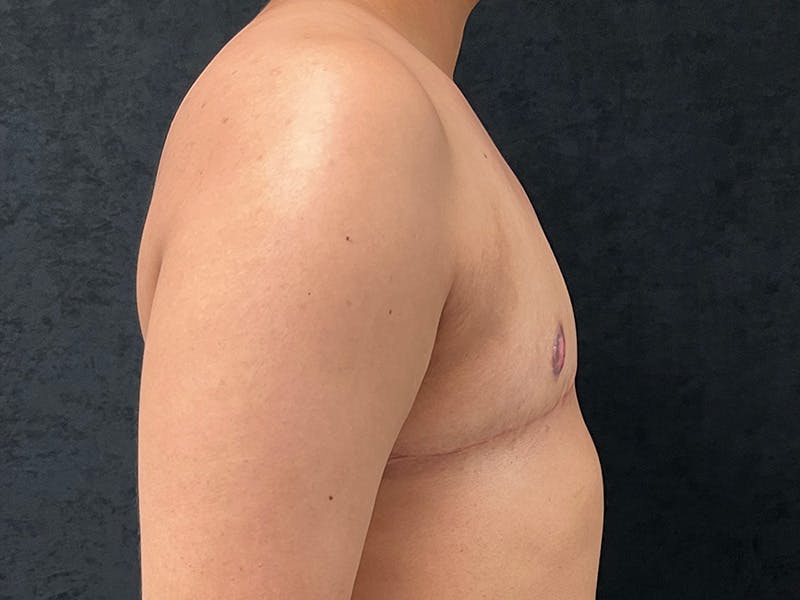 Transgender Top Surgery Before & After Gallery - Patient 225405 - Image 6