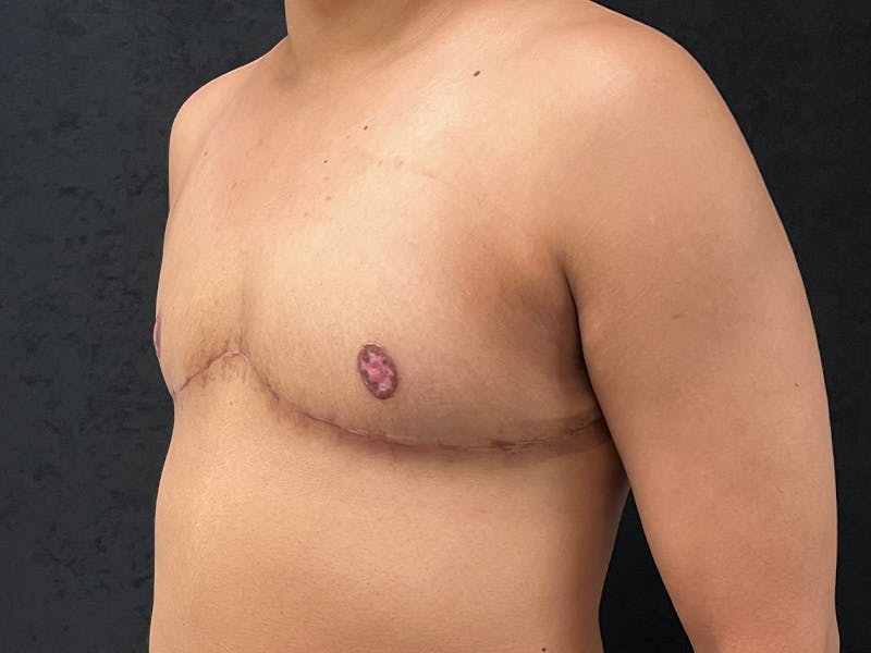 Transgender Top Surgery Before & After Gallery - Patient 225405 - Image 8