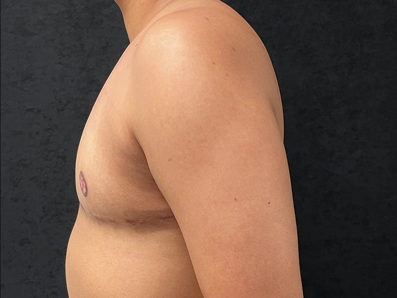 Transgender Top Surgery Before & After Gallery - Patient 225405 - Image 10