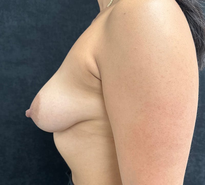 Breast Augmentation Subfascial Before & After Gallery - Patient 555276 - Image 7