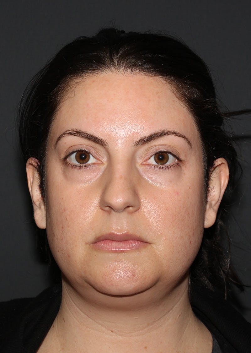 Facetite Before & After Gallery - Patient 110367 - Image 5