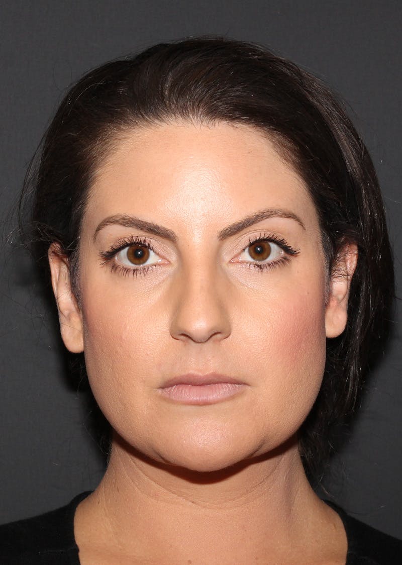 Facetite Before & After Gallery - Patient 110367 - Image 6