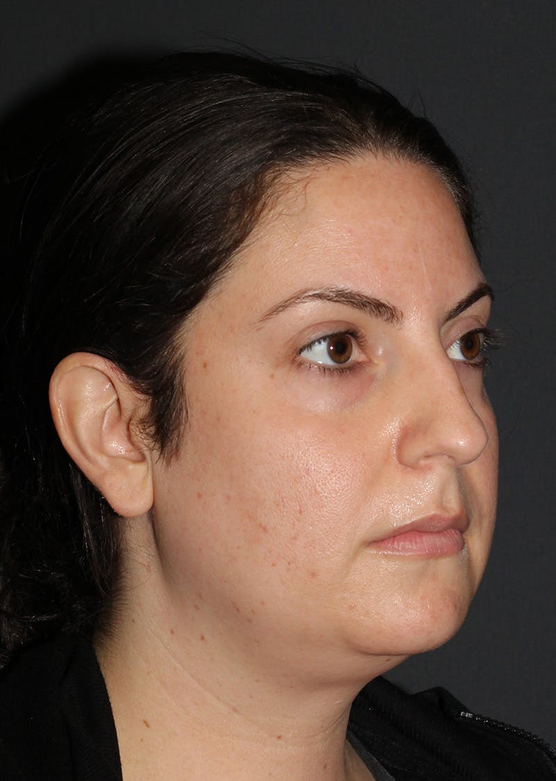 Facetite Before & After Gallery - Patient 110367 - Image 3