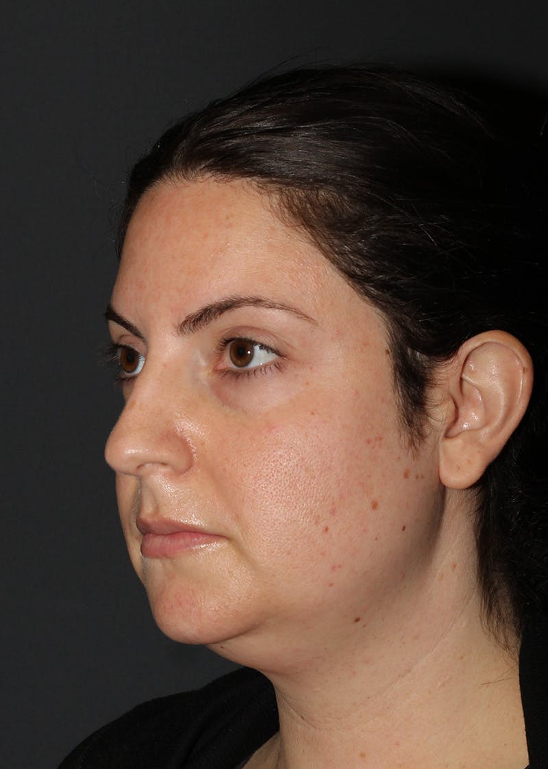 Facetite Before & After Gallery - Patient 110367 - Image 7