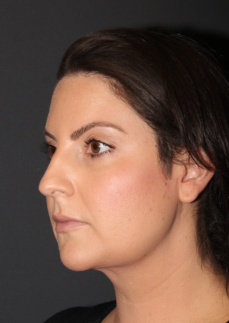 Facetite Before & After Gallery - Patient 110367 - Image 8